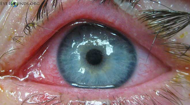 External photograph of the left eye showing a corneal epithelial defect and diffuse conjunctival injection