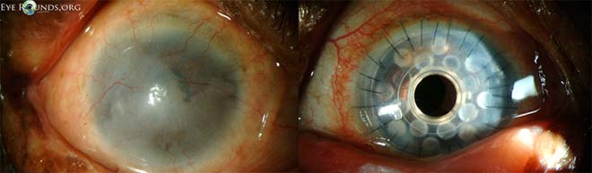 Outcome of Boston KPro type I for corneal conjunctivalization. This patient attained 20/25 vision following surgery