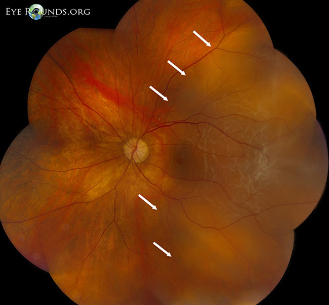Low magnification montage, rhegmatogenous macula-off retinal detachment