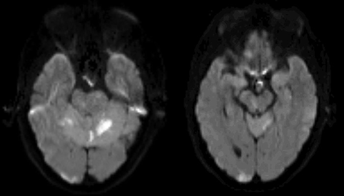 MRI axial diffusion-weighted imaging (DWI) showing hyperintensity (diffusion restriction) in the cerebellum, right occipital lobe, and right paramedian midbrain.
