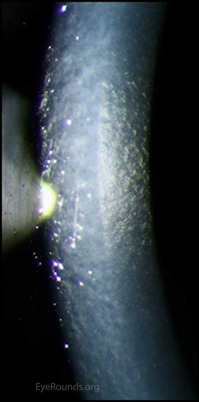 Slit lamp photo of endothelium: The right eye has notable dysmorphic endothelium that has mildly progressed.