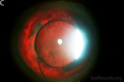 patient with congenital aniridia has 3-piece posterior chamber intraocular lenses in both eyes, as seen on retroillumination