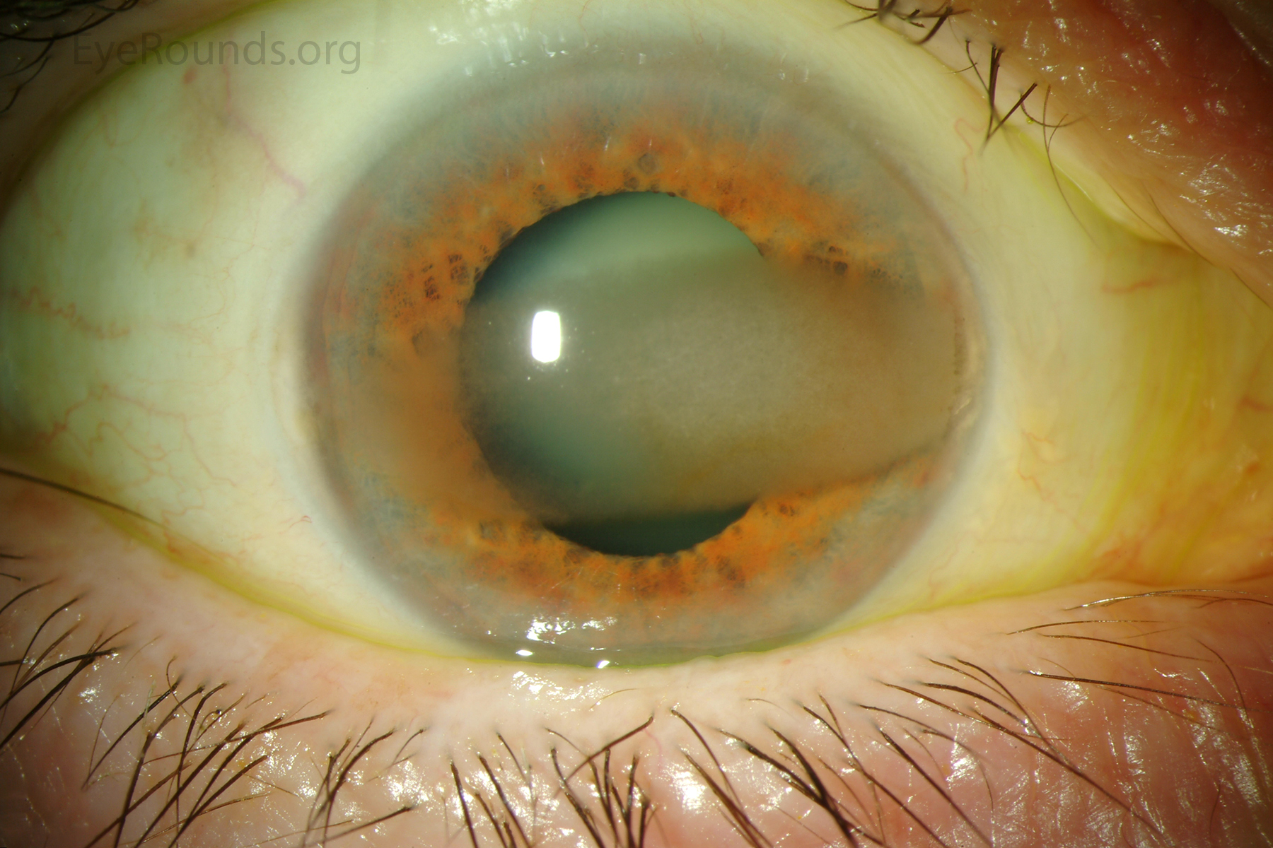 calcific-band-keratopathy