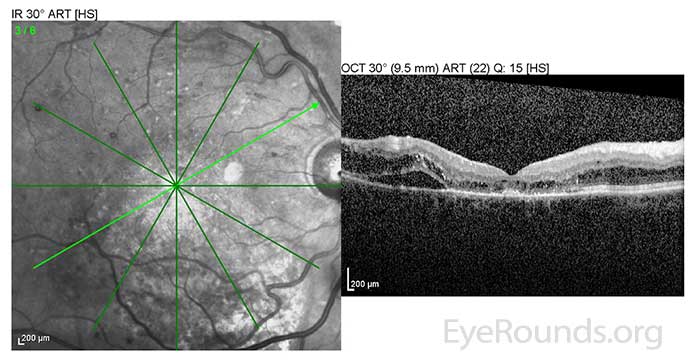 OD: Resolving macular detachment and surrounding CME.