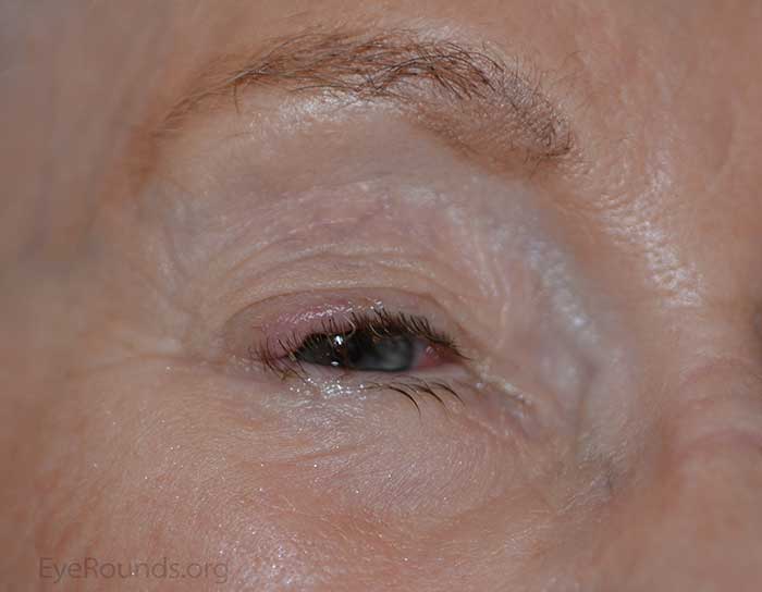 Another example of Merkel cell carcinoma presenting as a flesh-colored papule arising from the superotemporal portion of the upper eyelid.