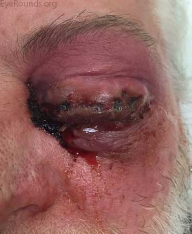 Tense left upper and lower eyelids, warmth, erythema with purplish hue, and edema extending to the upper and lower eyelid margin. Few eschars with purulent drainage.