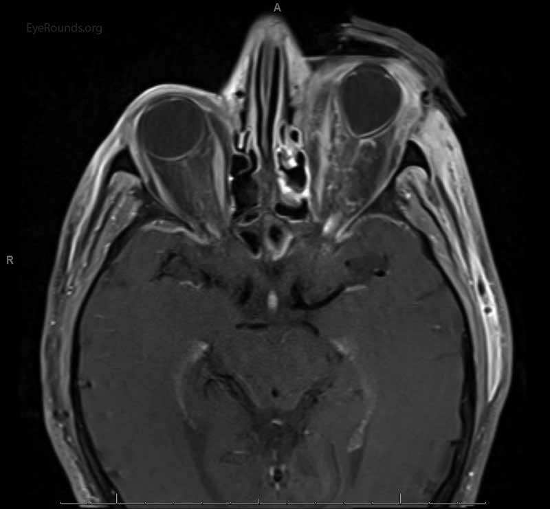 MRI with contrast showing tenting of the globe
