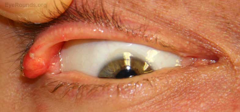 Large, erythematous upper eyelid lesion on the lateral canthus of the right eye with a smaller upper eyelid margin lesion medial to the larger lesion. Fullness of both upper eyelids with a yellow lower eyelid lesion near the puncta with scalloping of the medial lower eyelid on the left.