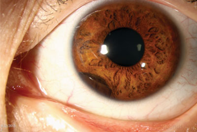Top left:  On slit lamp examination, a dark brown, pigmented lesion in the peripheral iris is seen extending from 6:30 to 8:00; there is no neovascularization of the iris and the pupil is round.