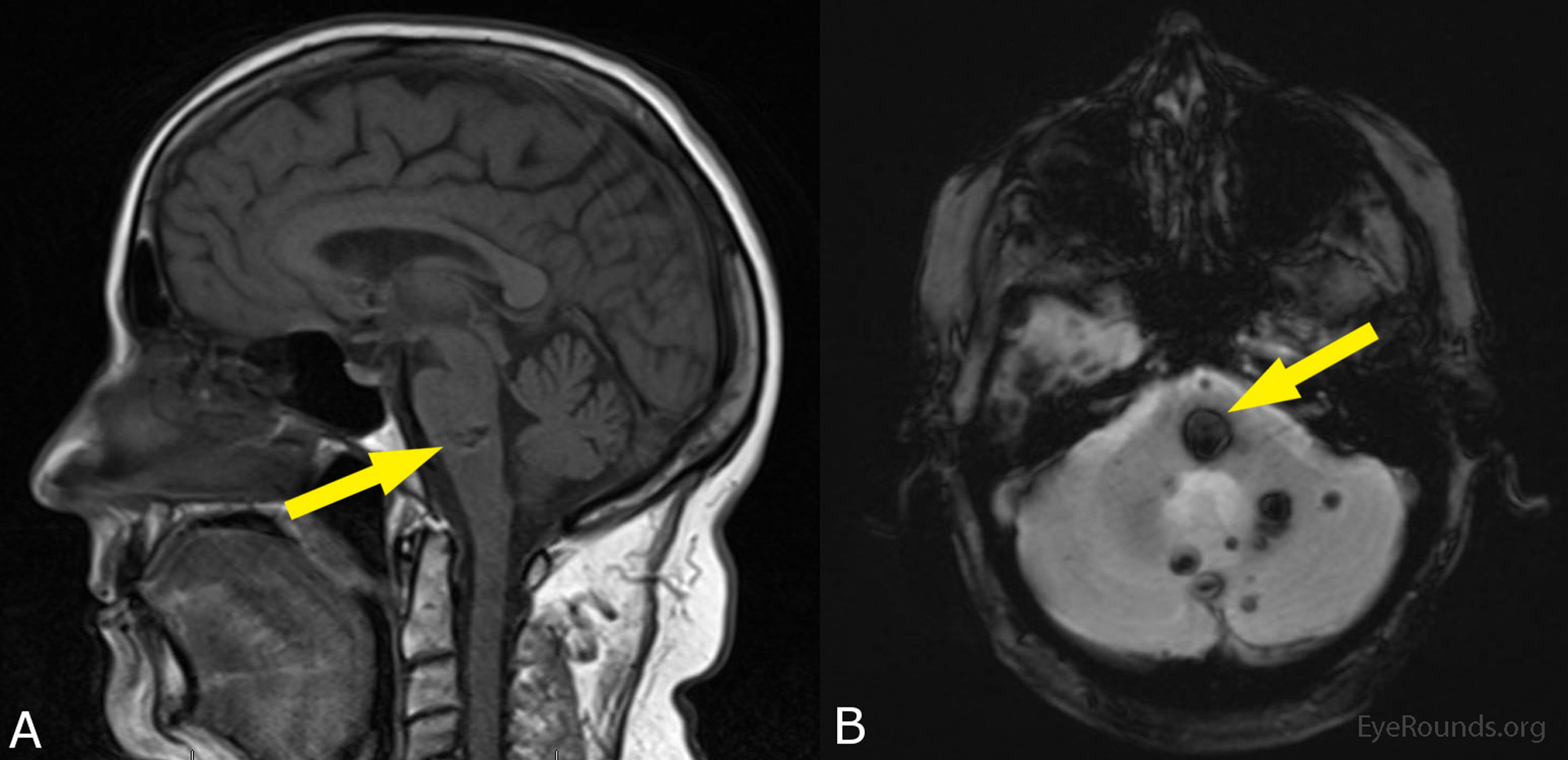 mri cerebral brain cavernoma brainstem syndrome lesions lesion multiple t1 imaging magnetic resonance cause showing half cases axial ophth uiowa