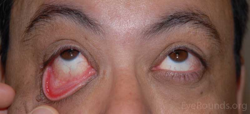 OD: lateral ptosis, significant eversion of the upper eyelid with minimal upward traction; significant lower eyelid laxity 
