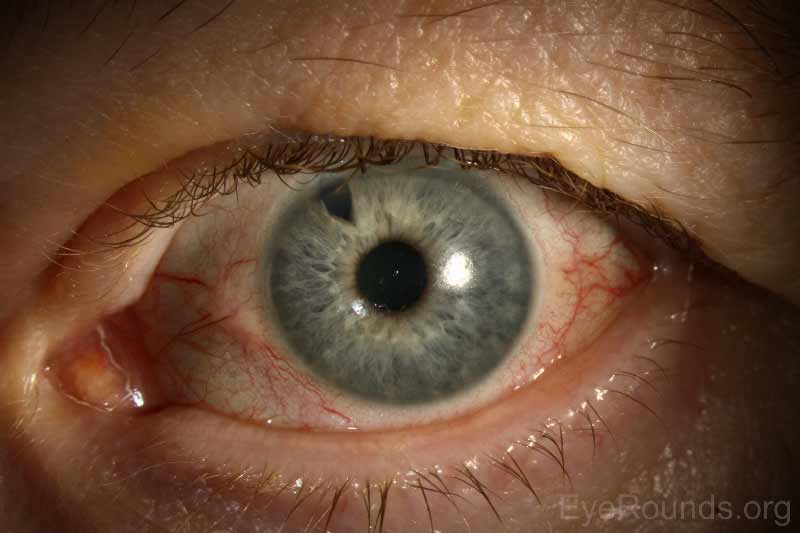 Slit lamp photograph of the left eye shows mild conjunctival injection. The pupil is irregular with posterior synechiae at 11 o'clock. The cornea is clear. The surgical PI is visible at 11 o'clock.