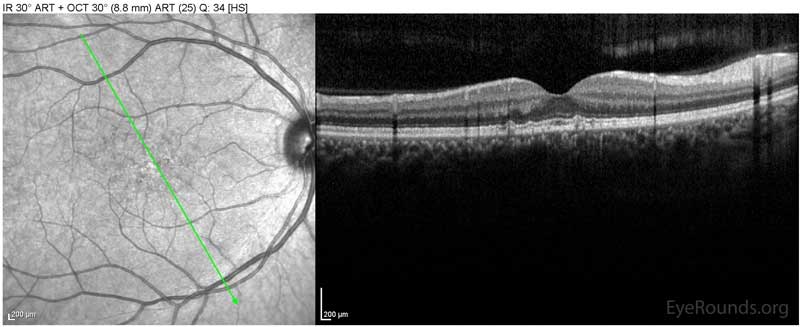 OCT OD Optical coherence tomography of both eyes. In both eyes, there are small drusen above Bruch's membrane without sub- or intraretinal fluid.