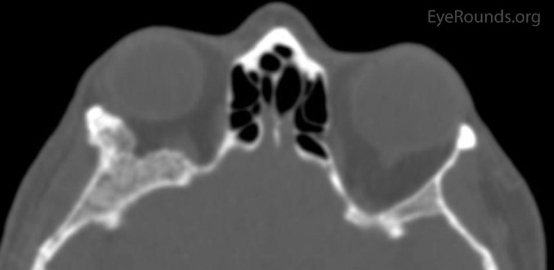 Figure 2: Orbital CT displaying a stable ground glass lesion of right greater wing of the sphenoid. (A: axial, B: coronal)