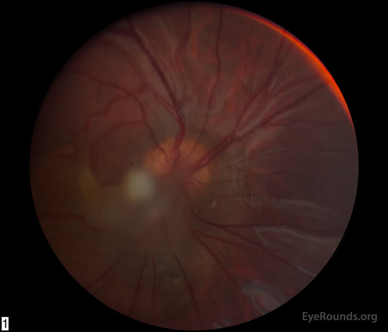 Color fundus photograph OD at age 6 demonstrating a hazy fibrotic vitreous stalk projecting from the optic disc, which appears hyperemic with blurred margins. There is evidence of peripapillary and macular retinal traction and subretinal fluid based on fine retinal folds and loss of visible choroidal detail underlying the stalk. 