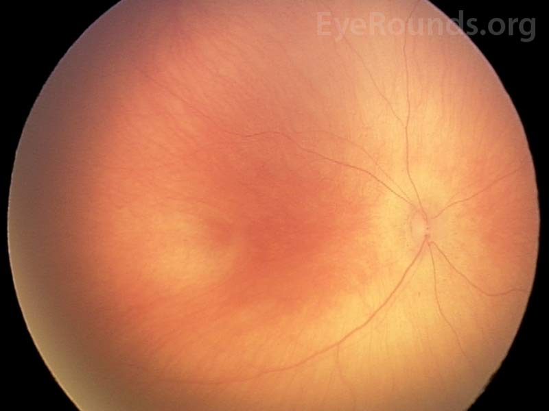 Fundus photo of stage 0 shows immature vascularization