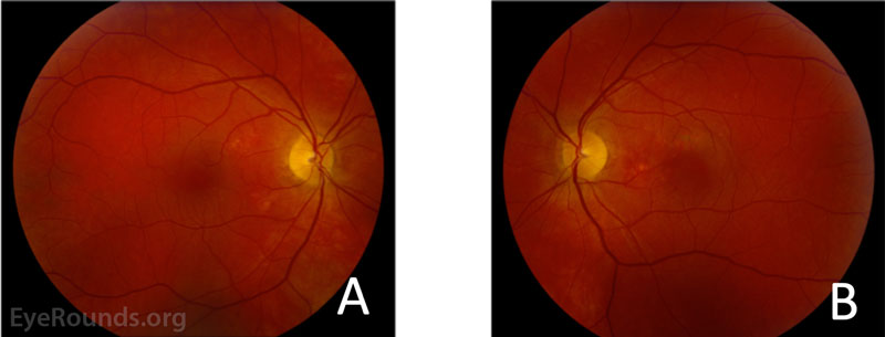 Fundus photography of the right (A) and left (B) eyes. The right eye demonstrated subtle hypopigmentary changes most apparent in the nasal macula, but no visible subretinal fluid, lipid, or heme. The left eye demonstrated subfoveal fluid with hyper- and hypopigmentary changes most prominent nasal and superior to the fovea.