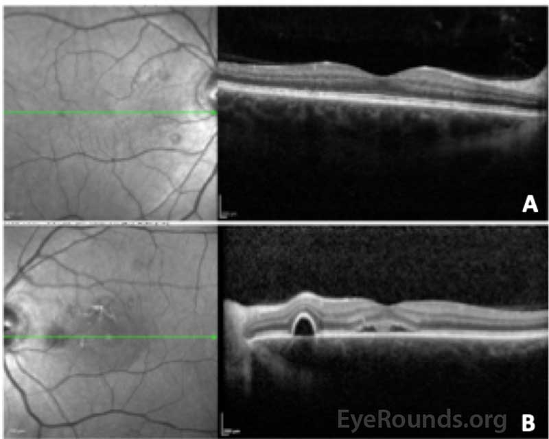 Optical coherence tomography of the right (A) and left (B) eyes at the 6-week follow up visit. The central macular thickness in the right eye was 275 microns (previously 274 microns) and there were several small serous pigment epithelial detachments nasal to the fovea without fluid. The central macular thickness in the left eye was 302 microns (previously 527 microns) and there was improved subfoveal fluid as well as smaller serous pigment epithelial detachments compared to previous. 