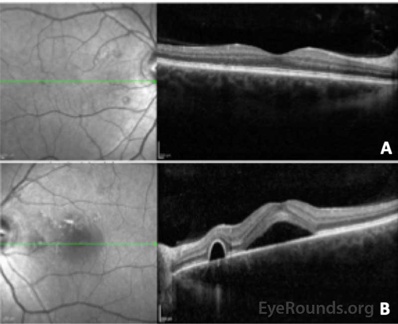 Optical coherence tomography of the right (A) and left (B) eye. In the right eye, the central macular thickness was 274 microns and there were several small serous pigment epithelial detachments nasal to the fovea without fluid. In the left eye, the central macular thickness 527 microns and there was subretinal fluid beneath the fovea with adjacent serous pigment epithelial detachments. The choroid was noted to be qualitatively thick in both eyes.