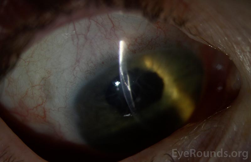 Color slit lamp photograph (narrow beam) of the right eye demonstrating hyperreflective cells extending along the clear corneal incision site.