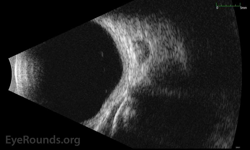 Pre-operative standardized echography of the right orbit showed a large low-reflective le sion in the inferonasal orbit indenting the globe.