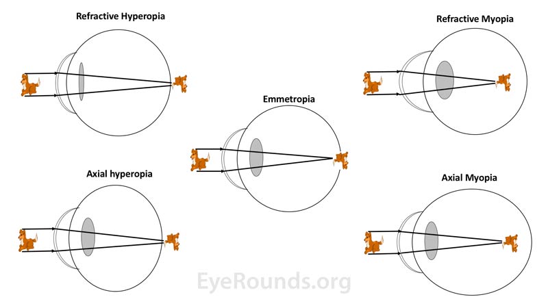 In cases of hyperopia (left side images) the refractive power of the eye is insufficient to focus the image onto the retina and/or the axial eye length is too short; thus the image is focused posterior to the retina. In cases of myopia (right side images) the refractive power of the eye is too strong or the axial eye length is too long; thus the image is focused anterior to the retina.