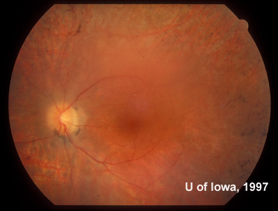 Sixty degree view of the posterior fundus, left eye demonstrates arteriolar narrowing and retinal pigment atrophy and bone-spicule changes. A posterior sclerotic cataract contributes to the hazy view. 