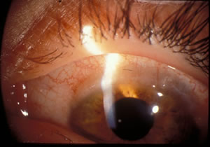 Left eye-Limbal conjunctivitis: broad, gelatinous, thickened, opacification of superior limbus. 