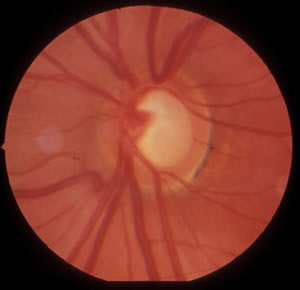 Juvenile Open Angle Glaucoma - Myocilin