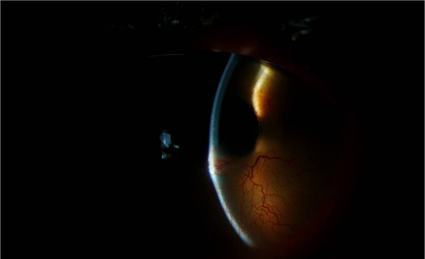 Phlyctenular Keratoconjunctivitis: year-old Female with figure 1c.jpg