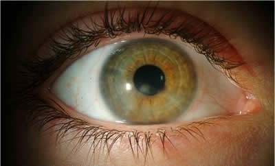 Corticosteroid ointment for eyes