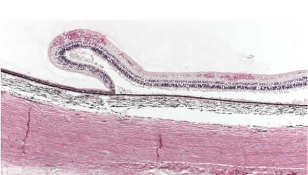Intraretinal hemorrhage extending to the far periphery. Lange's fold, which is an artifactual fold seen near the ora serrata at autopsy in eyes of infants, is pictured. 