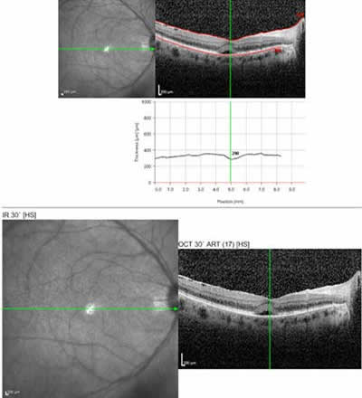 Optical Coherence Tomography, Birdshot Choroidopathy
