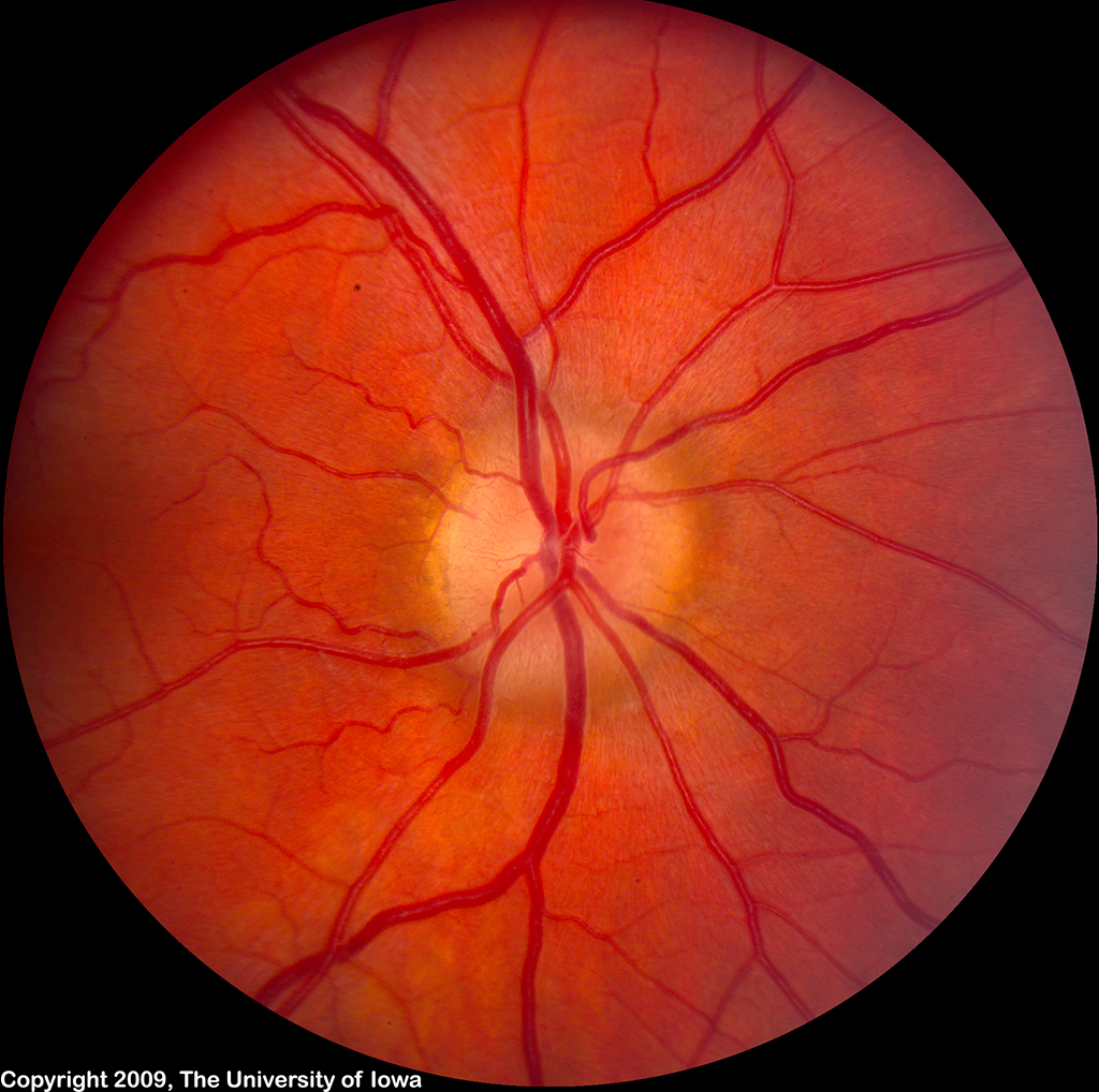 Idiopathic Intracranial Hypertension Pseudotumor Cerebri EyeRounds 