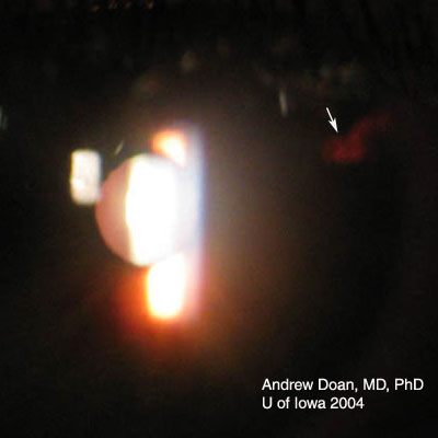 Intraocular Foreign Body (IOFB)