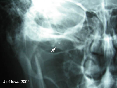 Intraocular Foreign Body (IOFB)