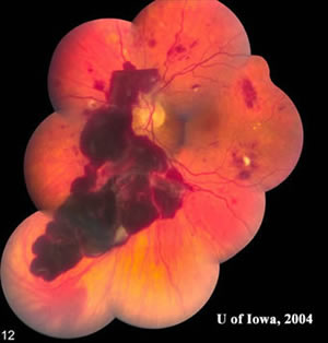subhyaloid retinal hemorrhages