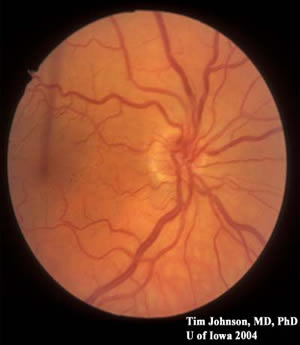 Dilated funduscopic examination showed severe, diffuse optic atrophy OD and bow-tie (band) optic atrophy OS