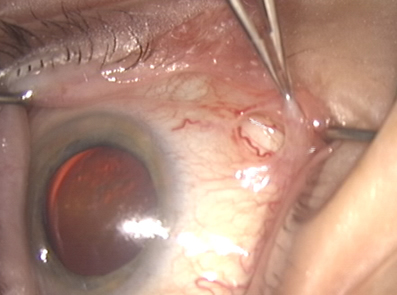 cannula insertion