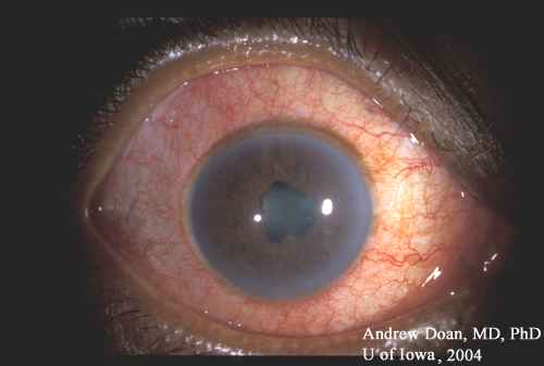 ocular tuberculosis