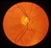 Low Tension or Normal Tension Glaucoma