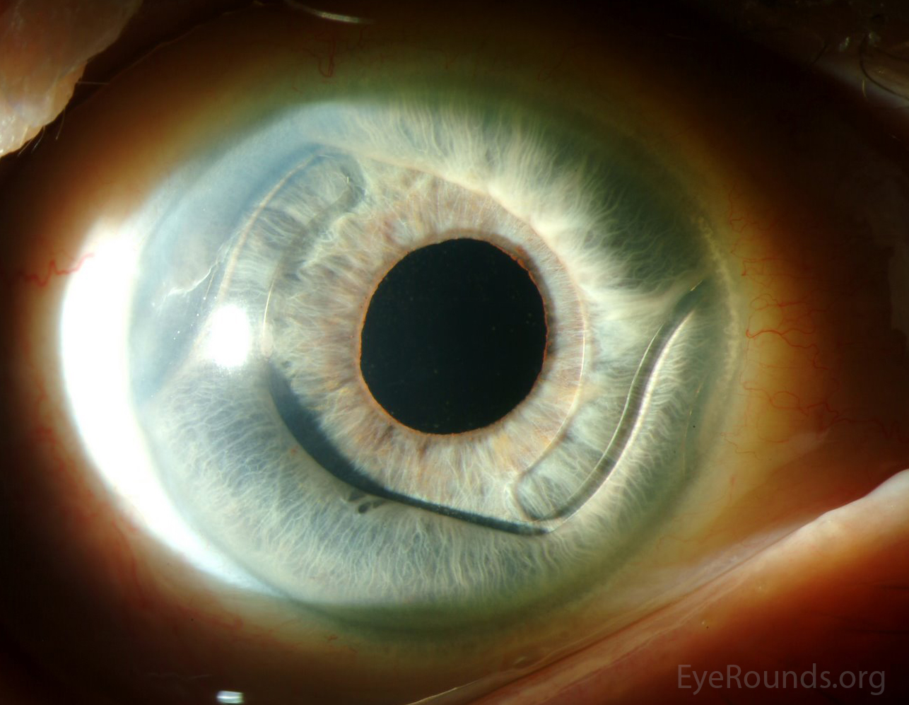 Anterior chamber intraocular lens (ACIOL)