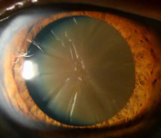 brunescent cataract