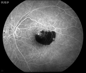 Fluorescein angiogram photograph of the patient