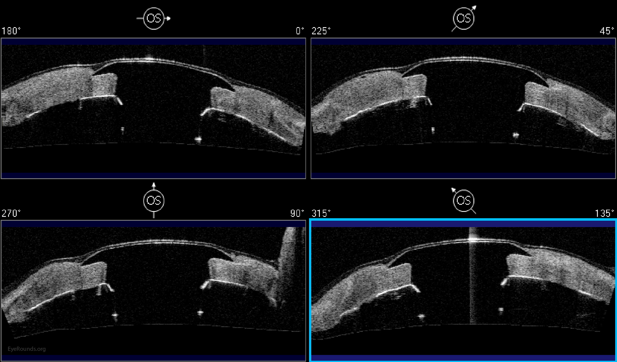 Anterior segment optical coherence tomography demonstrating the appearance of a Boston Type I Kpro