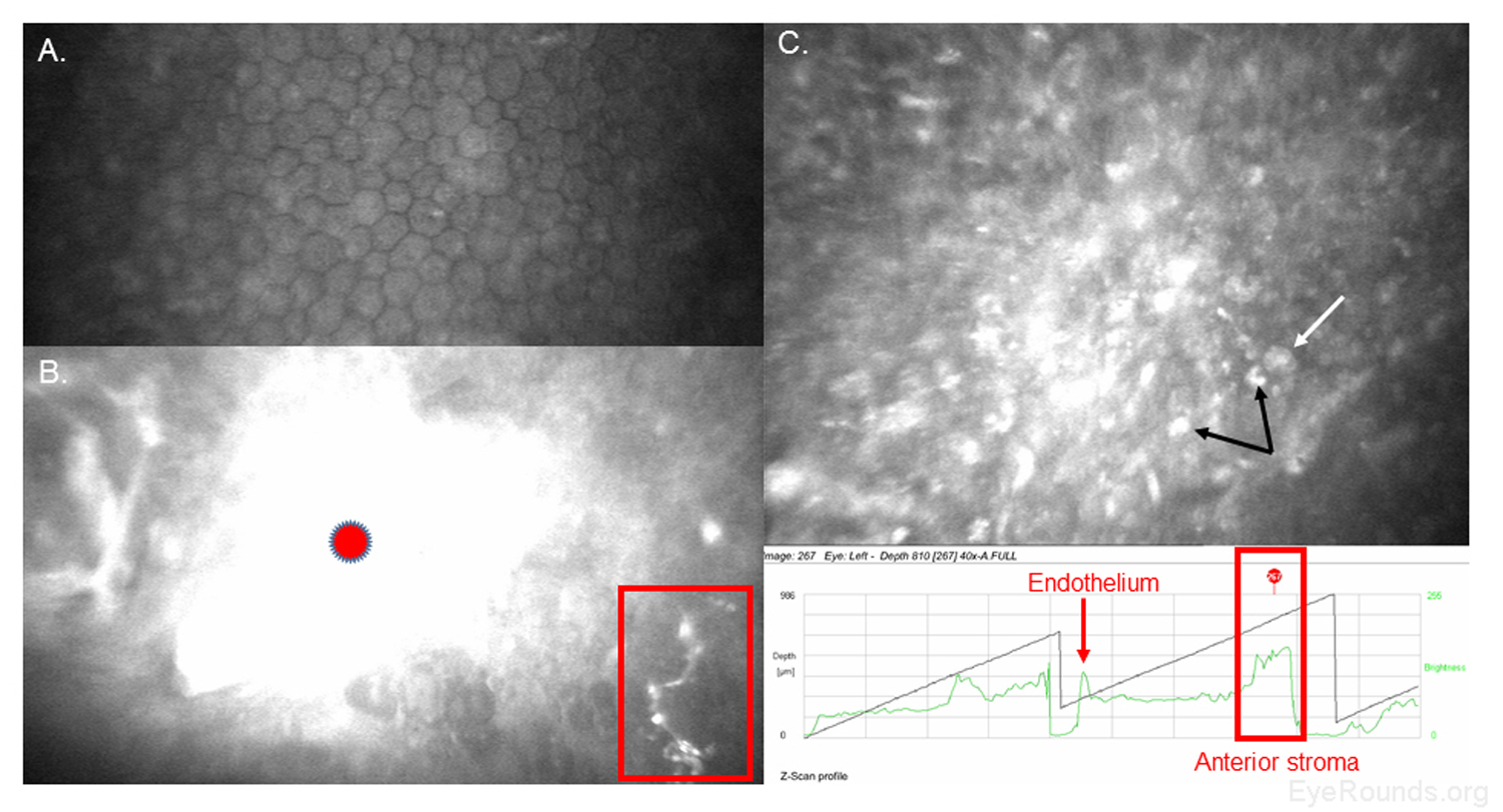 Confocal microscopy detection of Acanthamoeba and fungal keratitis in a contact lens user