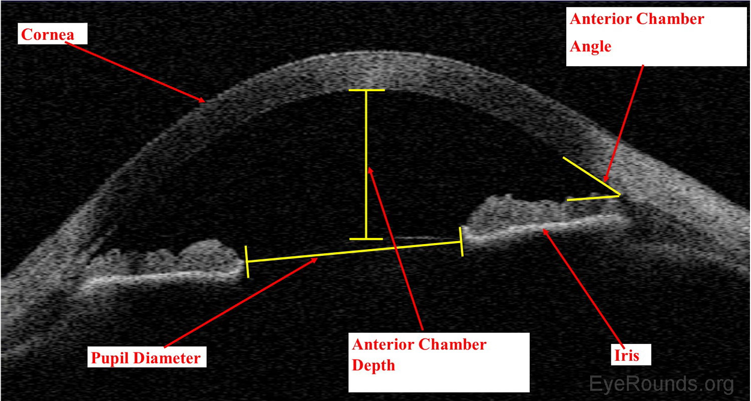 Visante AS-OCT showing normal anterior chamber anatomy