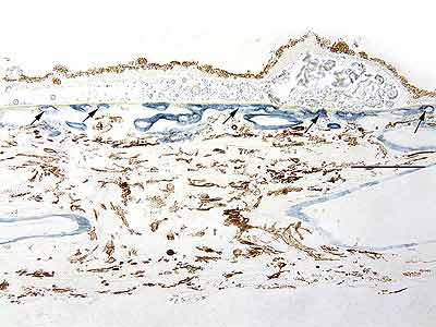 Figure 5A: Drusen - vasculature beneath choroid. 