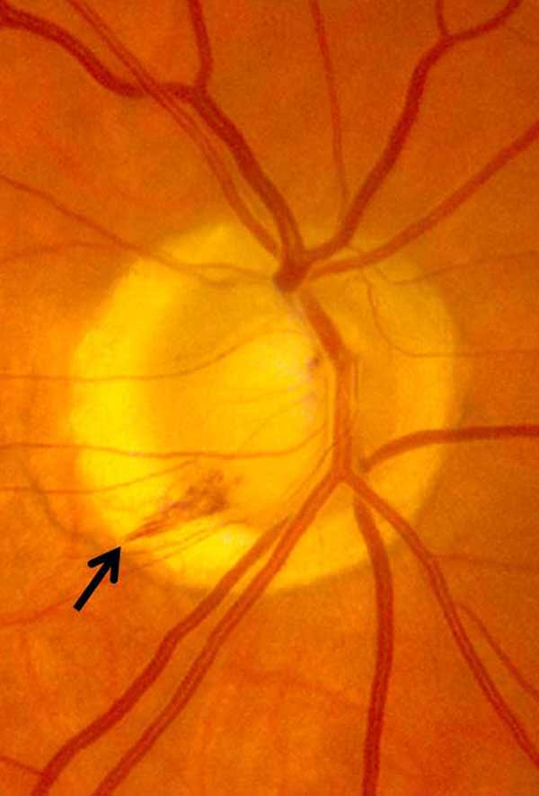 Optic nerve and open angle glaucoma