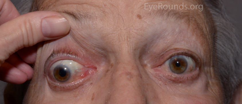 patient also had associated ophthalmoplegia 